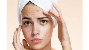 وصفات لحب الشباب