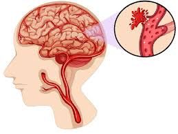أسباب نزيف الدماغ
